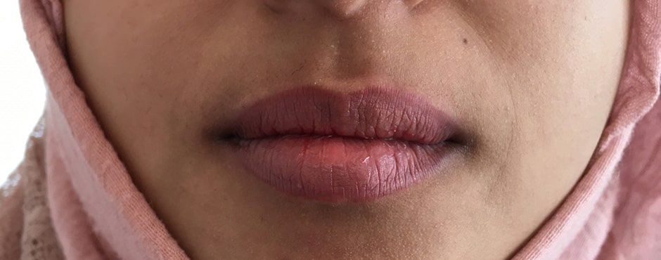 August Lips 2 After
