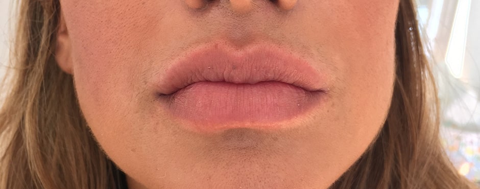 August Lips 4 Before