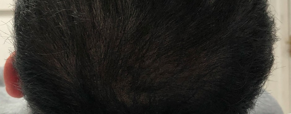 Sian Dellar Scalp Micropigmention Hair Tattoo After 4