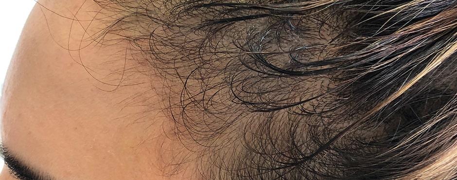 Sian Dellar Scalp Micropigmention Hair Tattoo Before 1