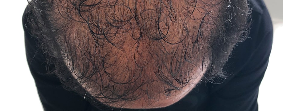 Sian Dellar Scalp Micropigmention Hair Tattoo Before 2
