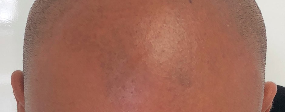 Sian Dellar Scalp Micropigmention Hair Tattoo Before 3