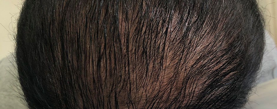 Sian Dellar Scalp Micropigmention Hair Tattoo Before 4